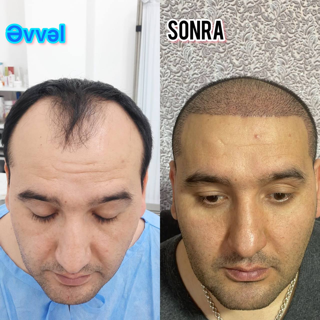 Əvvəl-Sonra