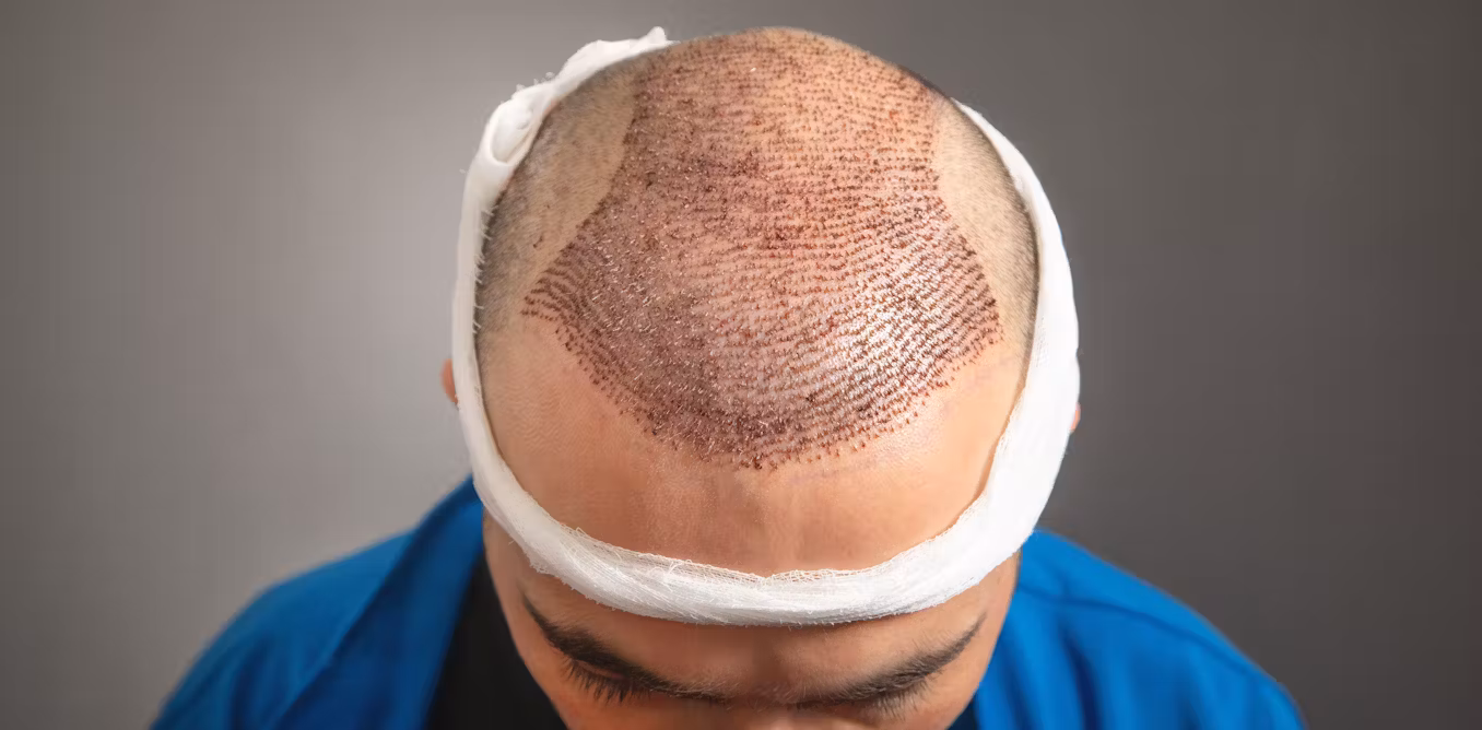 Saç Əkimi Prosedurası Haqqında