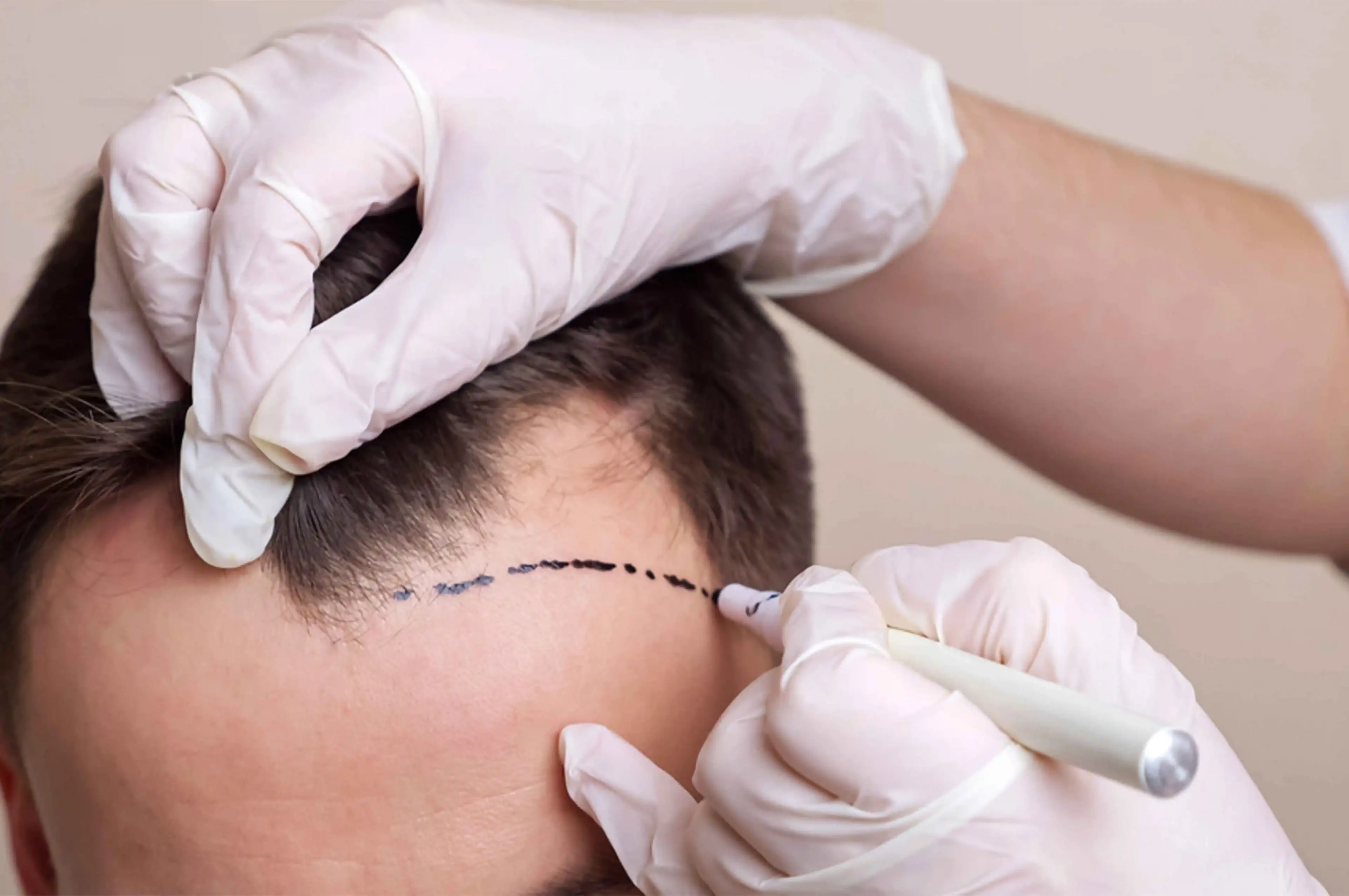 Saç Əkimindən Sonra Qulluq